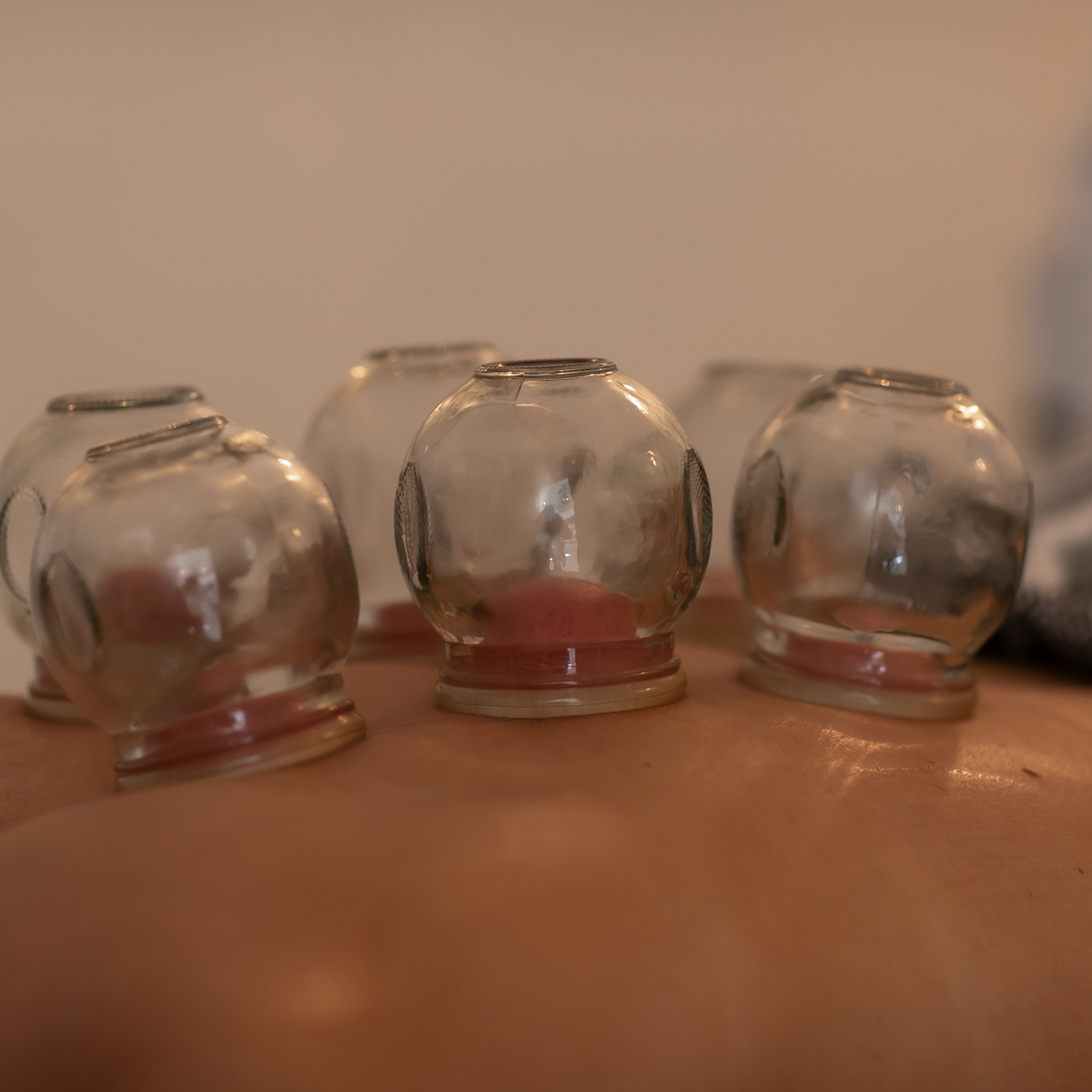 Here's What to Expect the First Time You Get Cupping