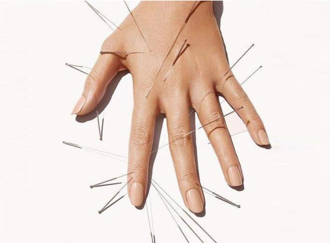 ACUPUNCTURE: THE ULTIMATE ALL-NATURAL PAIN REMEDY?